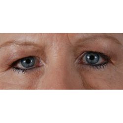 Blepharoplasty Before & After Patient #8090