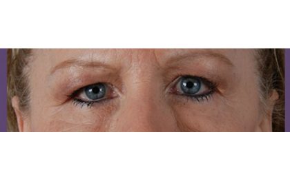Blepharoplasty Before & After Patient #8090
