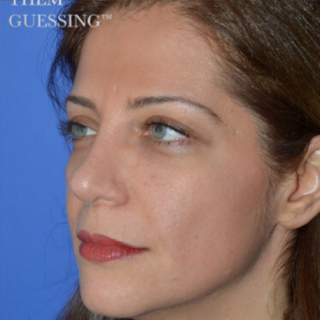 Rhinoplasty Before & After Patient #6858