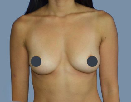Breast Augmentation Before & After Patient #9094