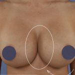 Breast Augmentation Before & After Patient #9101