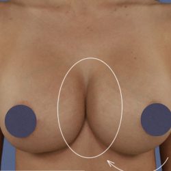 Breast Augmentation Before & After Patient #9101
