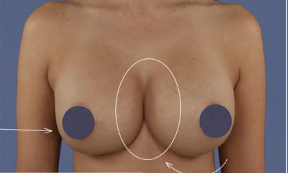 Breast Augmentation Before & After Patient #9101