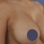 Breast Augmentation Before & After Patient #9101