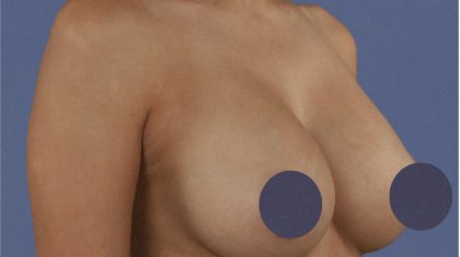 Breast Augmentation Before & After Patient #9101