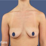 Breast Augmentation Before & After Patient #9110