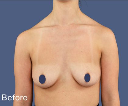 Breast Augmentation Before & After Patient #9110