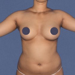 Liposuction Before & After Patient #7459