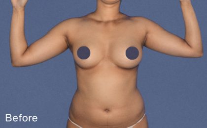Liposuction Before & After Patient #7459