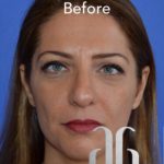 Rhinoplasty Before & After Patient #6858