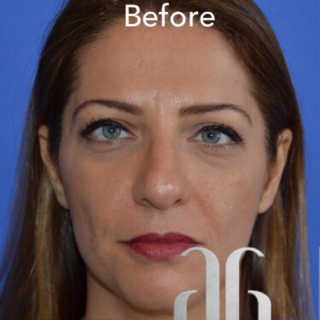 Rhinoplasty Before & After Patient #6858