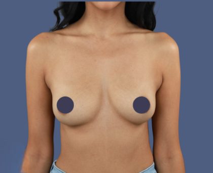 Breast Augmentation Before & After Patient #9091