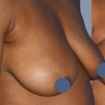 Breast Augmentation Before & After Patient #9104
