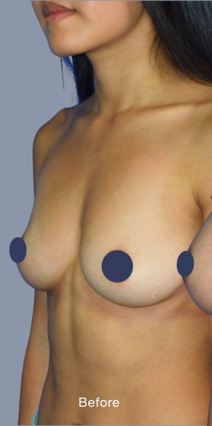 Breast Augmentation Before & After Patient #9115