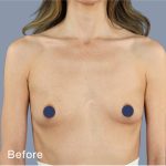 Breast Augmentation Before & After Patient #9118
