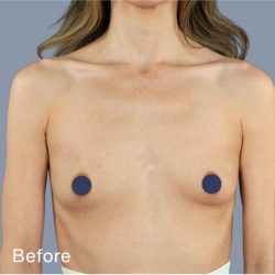 Breast Augmentation Before & After Patient #9118