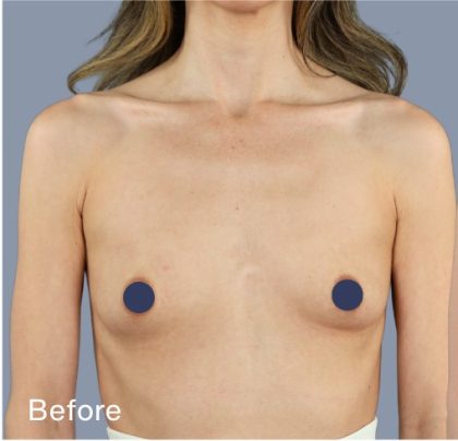 Breast Augmentation Before & After Patient #9118