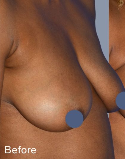 Breast Augmentation Before & After Patient #9104