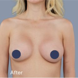 Breast Augmentation Before & After Patient #9118
