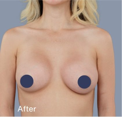 Breast Augmentation Before & After Patient #9118