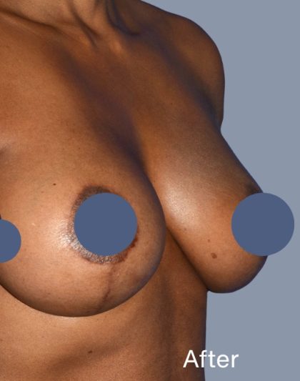 Breast Augmentation Before & After Patient #9104