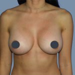 Breast Augmentation Before & After Patient #9094