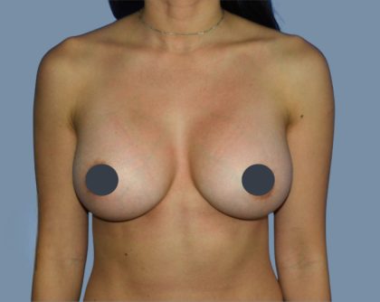Breast Augmentation Before & After Patient #9094