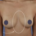 Breast Augmentation Before & After Patient #9101