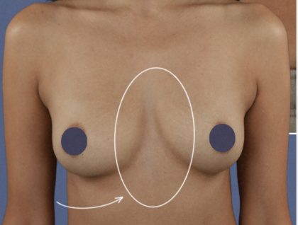 Breast Augmentation Before & After Patient #9101