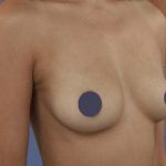 Breast Augmentation Before & After Patient #9101