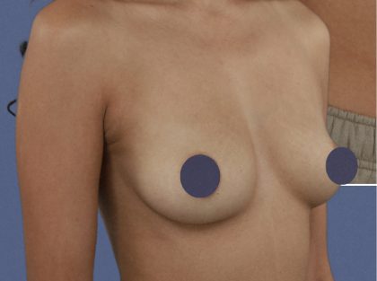 Breast Augmentation Before & After Patient #9101