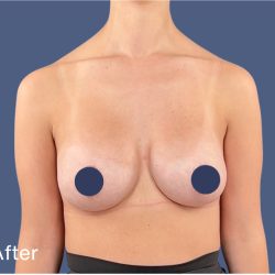 Breast Augmentation Before & After Patient #9110