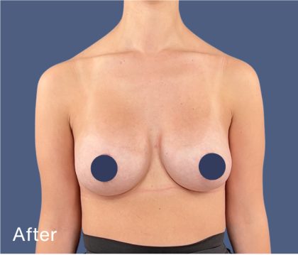 Breast Augmentation Before & After Patient #9110
