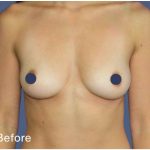 Breast Augmentation Before & After Patient #9115