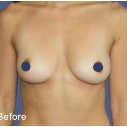 Breast Augmentation Before & After Patient #9115