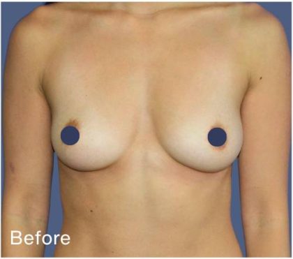 Breast Augmentation Before & After Patient #9115