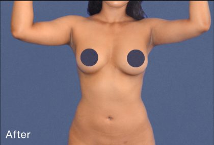 Liposuction Before & After Patient #7459