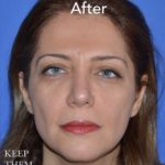 Rhinoplasty Before & After Patient #6858