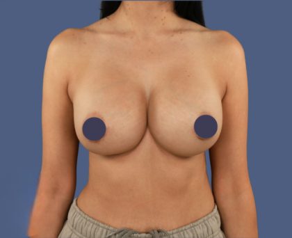 Breast Augmentation Before & After Patient #9091