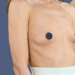 Breast Augmentation Before & After Patient #9118