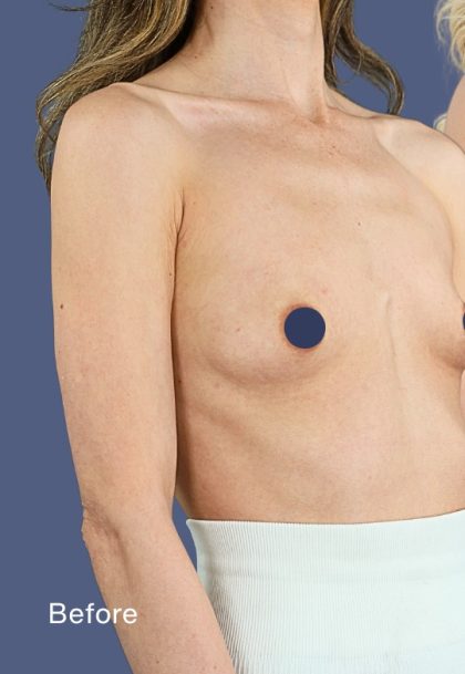 Breast Augmentation Before & After Patient #9118