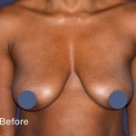 Breast Augmentation Before & After Patient #9104