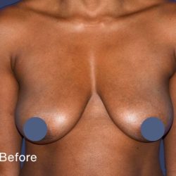 Breast Augmentation Before & After Patient #9104