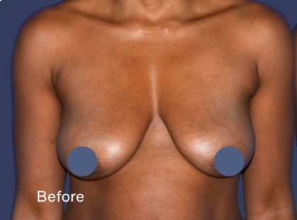 Breast Augmentation Before & After Patient #9104
