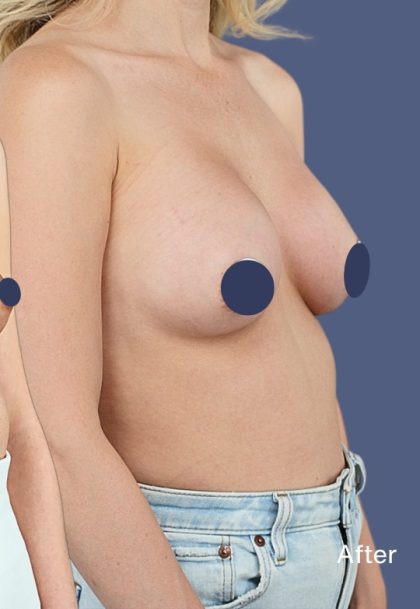 Breast Augmentation Before & After Patient #9118
