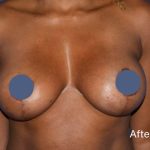 Breast Augmentation Before & After Patient #9104