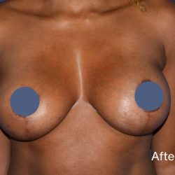 Breast Augmentation Before & After Patient #9104
