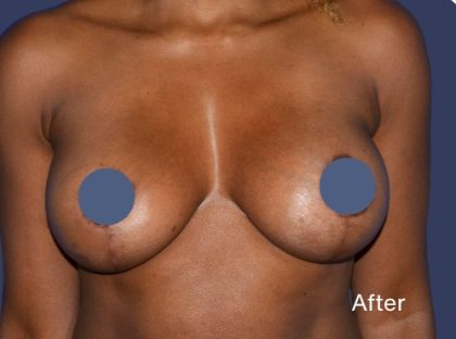 Breast Augmentation Before & After Patient #9104