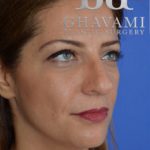 Rhinoplasty Before & After Patient #6858