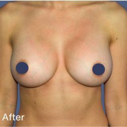 Breast Augmentation Before & After Patient #9115